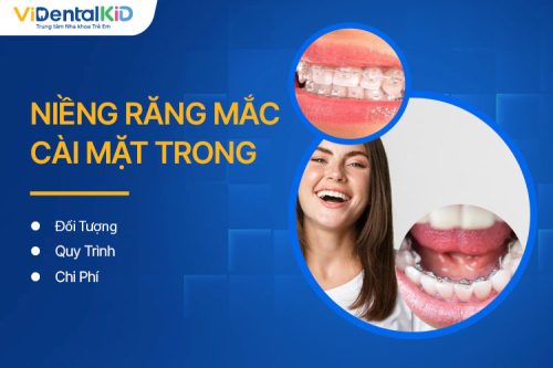 Niềng Răng Mắc Cài Mặt Trong Có Tốt Không? Chi Phí Bao Nhiêu?