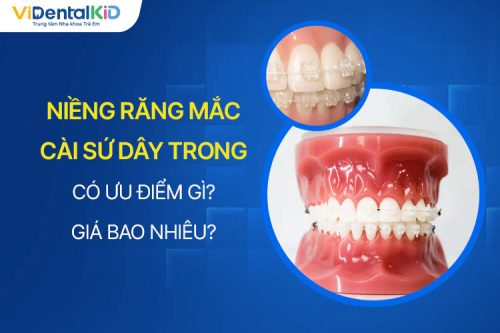 Niềng Răng Mắc Cài Sứ Dây Trong Tốt Không? Giá Bao Nhiêu?