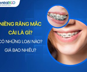 Niềng Răng Mắc Cài Có Những Loại Nào? Chi Phí Bao Nhiêu?