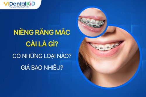 Niềng Răng Mắc Cài Có Những Loại Nào? Chi Phí Bao Nhiêu?