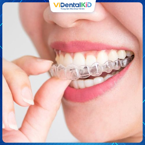 Invisalign là phương pháp có mức giá cao nhất