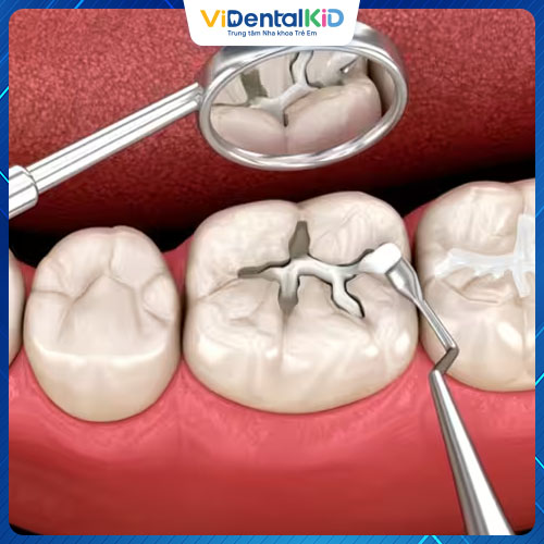 Amalgam là vật liệu trám có mức giá rẻ