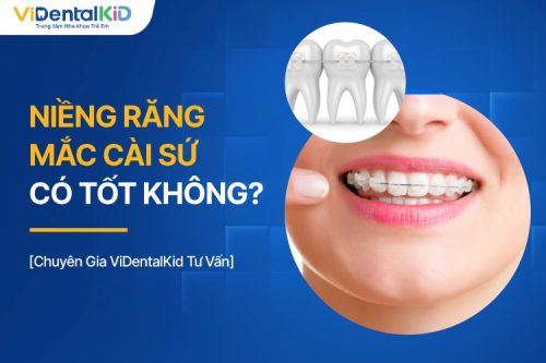 Niềng Răng Mắc Cài Sứ Giá Bao Nhiêu? Có Gì Nổi Bật?